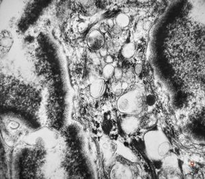 M,66y. | follicular cyst with hyaline Rushton bodies M,66y. | follicular cyst with hyaline Rushton bodies